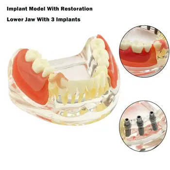 Стоматологичен Модел На Долните Зъби Подвижна Художествени Възстановяване Мостовидный Протеза Демо Прозрачна Акрилна Основа M6006